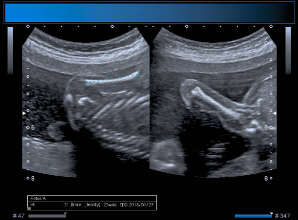 istock Identical twin boy obstetrical ultrasound 963176578