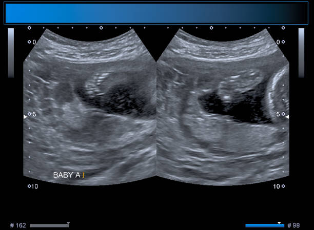istock Identical twin boy obstetrical ultrasound 963176620