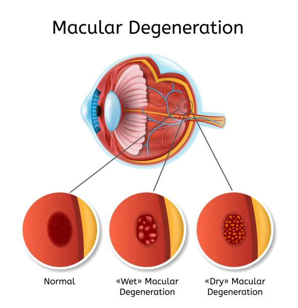 illustrations, cliparts, dessins animés et icônes de régime maladie de dégénérescence maculaire vector - dégénératif