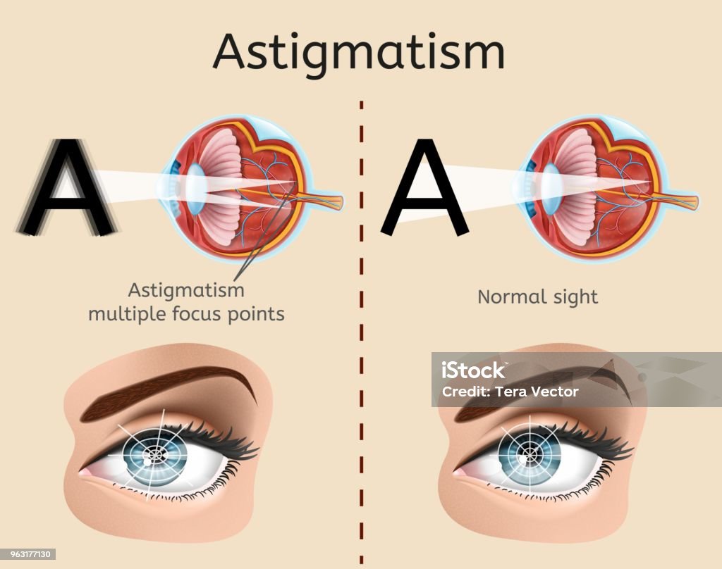 Diagram Atau Skema Vektor Medis Astigmatisme Ilustrasi Stok Unduh astigmatism-causes-types-symptoms-treatment-lenses-refractive-surgery