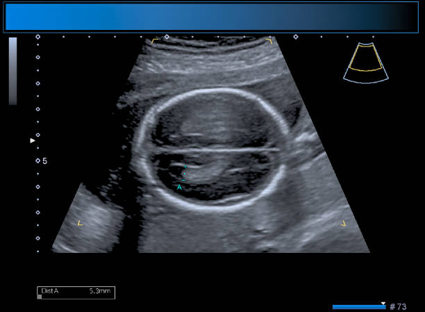 identyczne bliźniacze usg położnicze chłopca - twin fetus uterus human pregnancy zdjęcia i obrazy z banku zdjęć