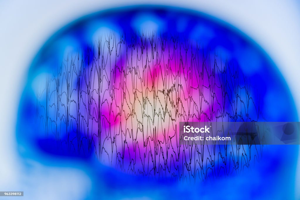 Anormal beyin, electroencephalogram, EEG elektriksel aktivitesinin ile EEG - Royalty-free Epilepsi Stok görsel