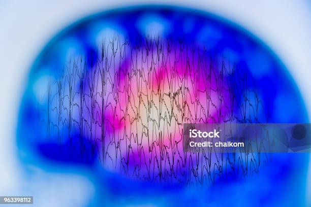 Anormal Beyin Electroencephalogram Eeg Elektriksel Aktivitesinin Ile Eeg Stok Fotoğraflar & Epilepsi‘nin Daha Fazla Resimleri