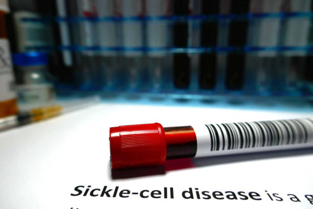 Sickle-cell disease stock photo