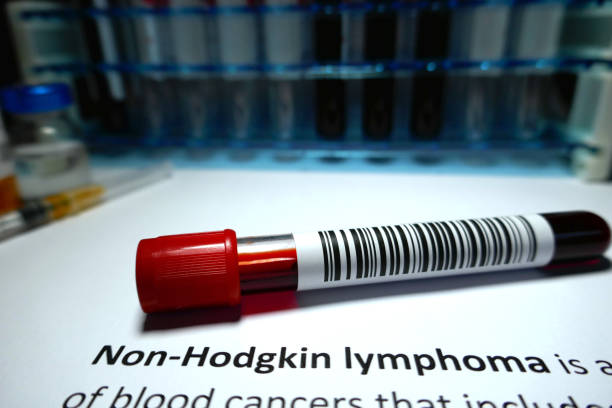 non-hodgkin lymphoma - non hodgkin lymphoma imagens e fotografias de stock