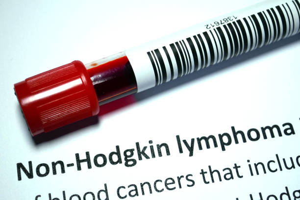 doença não-hodgkin - non hodgkin lymphoma - fotografias e filmes do acervo