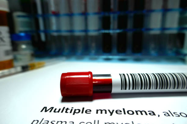 Multiple myeloma stock photo