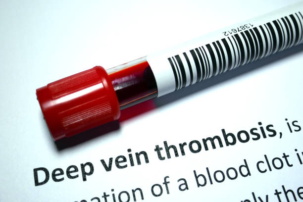 Deep venous thrombosis Deep vein thrombosis - blood disorder abstract. blood clot photos stock pictures, royalty-free photos & images