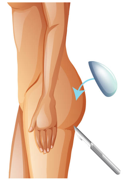 A Vector of Buttock Augmentation A Vector of Buttock Augmentation illustration silicone implants stock illustrations
