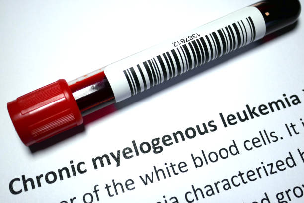 Chronic myeloid leukemia stock photo
