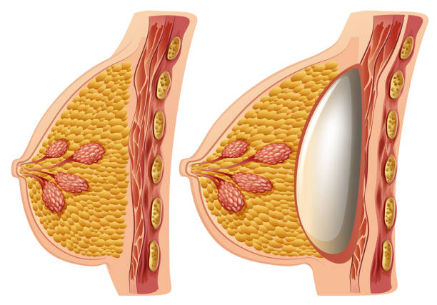 A Vector of Female Breast Implants A Vector of Female Breast Implants illustration silicone implants stock illustrations