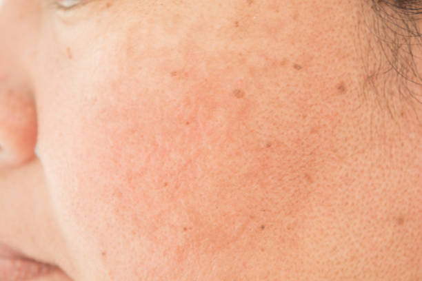 istock Pores on the face in women 964129930