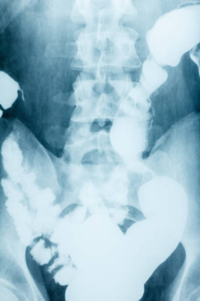 рентгеновское изображение простой живот , толстой кишки - descending colon стоковые фото и изображения
