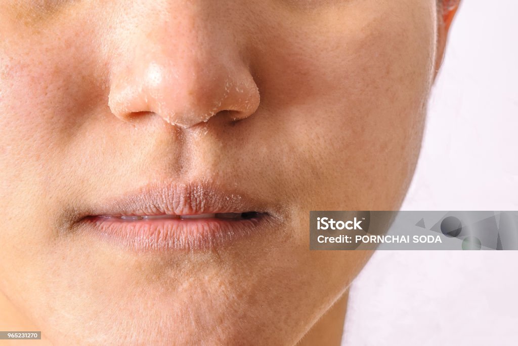 Allergische Frauen haben Neurodermitis trockene Nase und Lippen auf Winter Saison Closeup. - Lizenzfrei Haut Stock-Foto