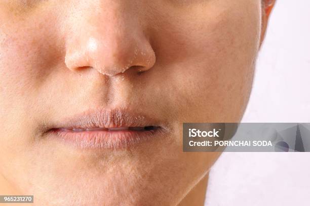 Allergic Women Have Eczema Dry Nose And Lips On Winter Season Closeup Stock Photo - Download Image Now