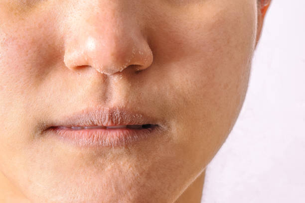 as mulheres alérgicas têm eczema seco nariz e lábios em closeup de temporada de inverno. - casca de fruta - fotografias e filmes do acervo