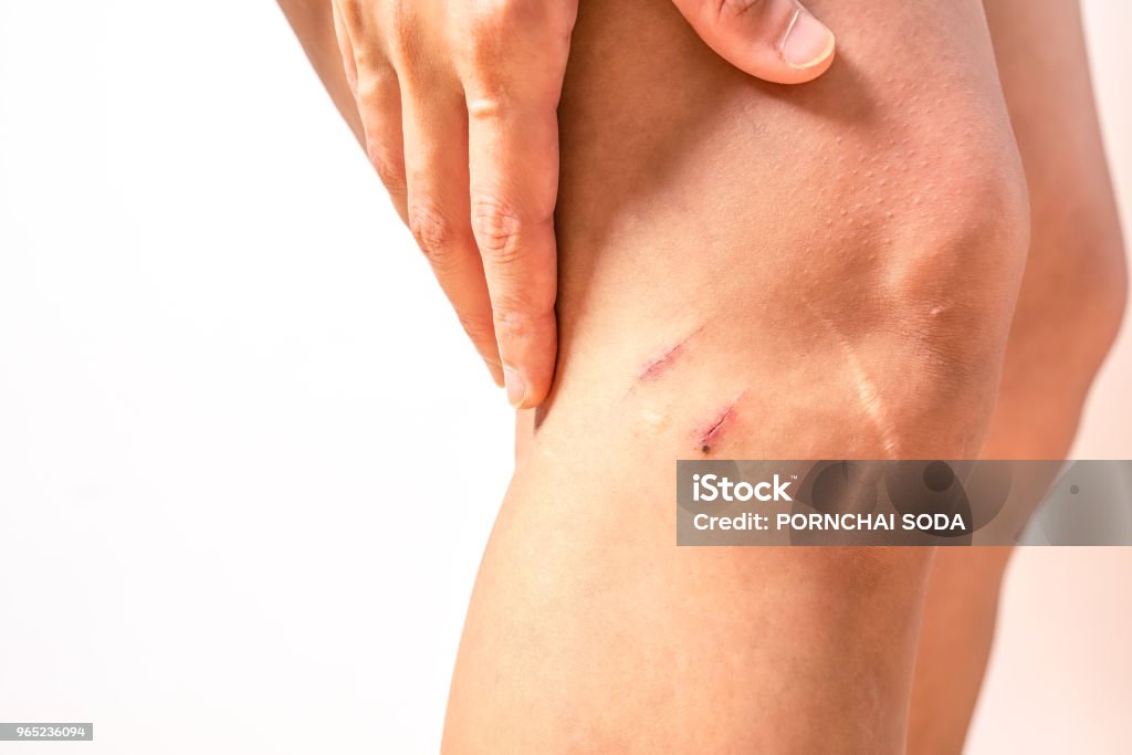 two scratch wound on female knee with big scar closeup, healthcare and medicine concept Scar Stock Photo