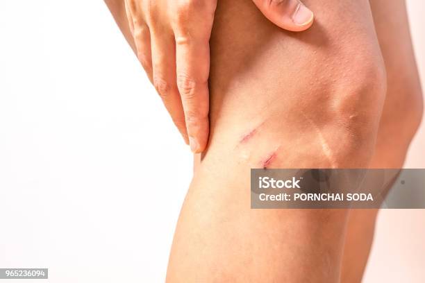 Two Scratch Wound On Female Knee With Big Scar Closeup Healthcare And Medicine Concept Stock Photo - Download Image Now