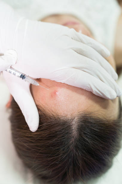 istock Cosmetologist in spa beauty salon doing acne treatment using mechanical instrument. 965325460