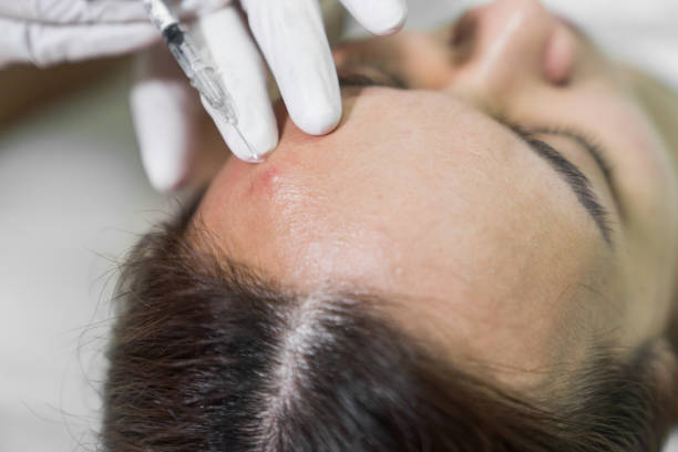 istock Cosmetologist in spa beauty salon doing acne treatment using mechanical instrument. 965325468