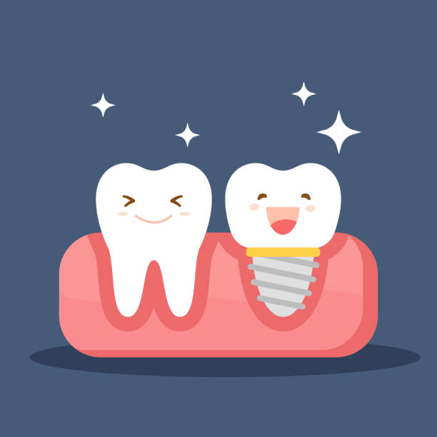 implant dentystyczny i normalny ząb. przywrócenie w jamie ustnej. płaska ilustracja na temat stomatologii. ilustracja wektorowa izolowana na niebieskim tle. - dentist pain human teeth toothache stock illustrations