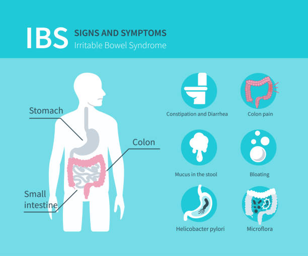 irritable bowel syndrome Irritable bowel syndrome concept design for web banners, infographics. IBS signs and symptoms set. Flat style vector illustration. irritable bowel syndrome stock illustrations