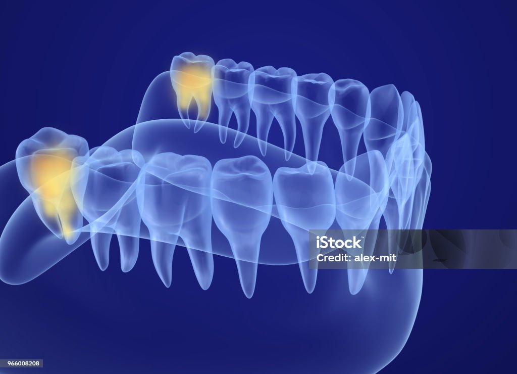 Wisdom tooth xray view. Medically accurate tooth 3D illustration Wisdom Stock Photo