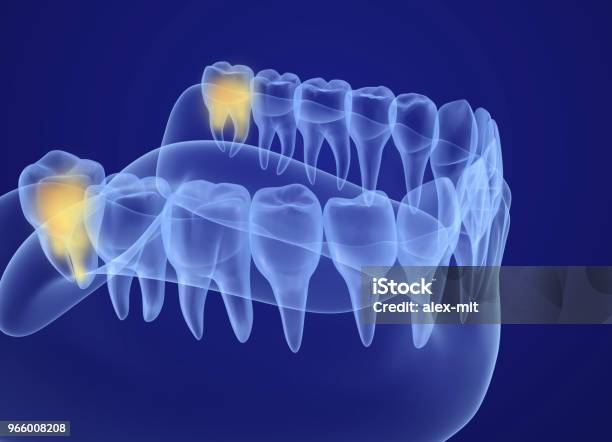 Wisdom Tooth Xray View Medically Accurate Tooth 3d Illustration Stock Photo - Download Image Now