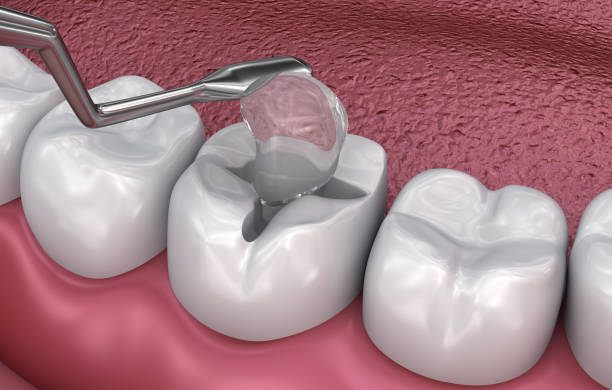 istock Dental fissure fillings, Medically accurate 3D illustration 966015420