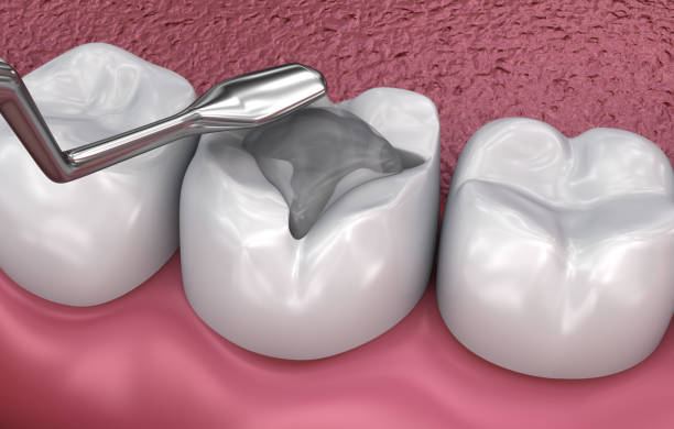 istock Dental fissure fillings, Medically accurate 3D illustration 966015928