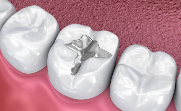 istock Dental fissure fillings, Medically accurate 3D illustration 966016092