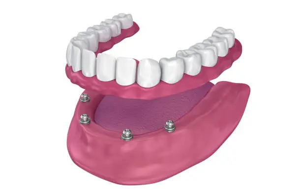 Overdenture to be seated on implants - ball attachments. 3D illustration