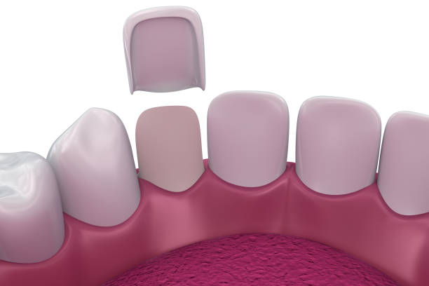 dental veneers: porcelain veneer installation procedure. 3d illustration - recreate imagens e fotografias de stock