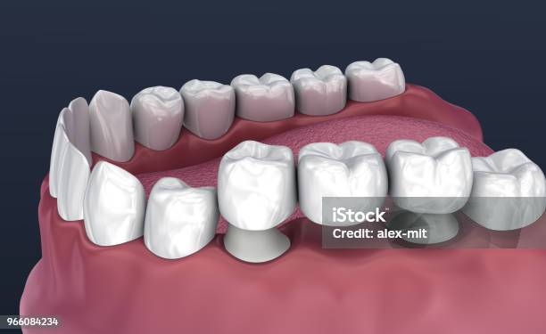 Zahn Unterstützt Feste Brücke 3 Zähne Medizinisch Genaue 3dillustration Stockfoto und mehr Bilder von Abschirmen