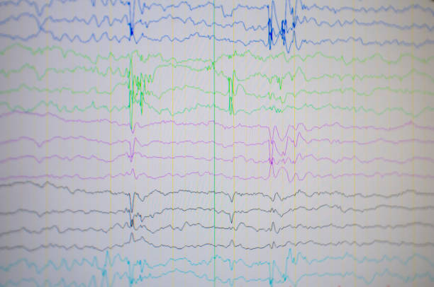 istock A computer monitor showing electrical activity of abnormal brain, electroencephalogram,EEG 966419854
