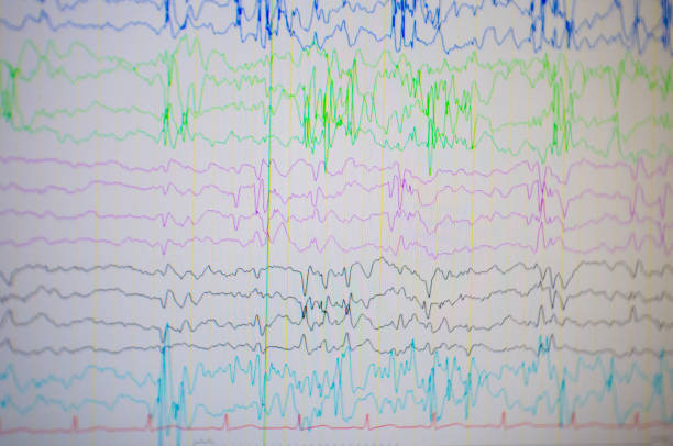 istock A computer monitor showing electrical activity of abnormal brain, electroencephalogram,EEG 966422072