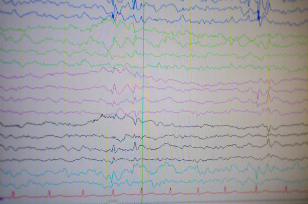istock A computer monitor showing electrical activity of abnormal brain, electroencephalogram,EEG 966425402