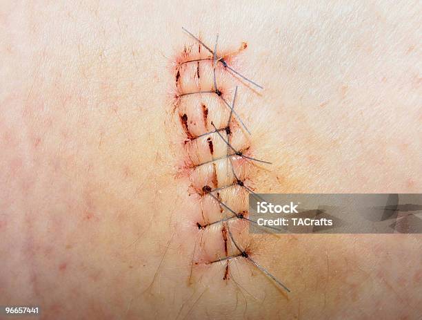 Stitch Up Stock Photo - Download Image Now - Bruise, Color Image, Emergency Services Occupation