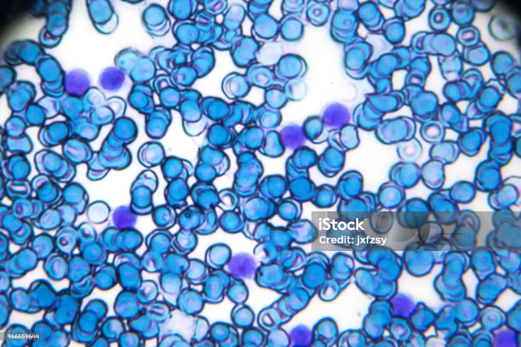 Acute lymphoblastic leukemia ALL-L2 blood smear under light microscopy Leukemia Stock Photo