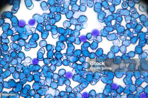 Acute Lymphoblastic Leukemia Alll2 Blood Smear Under Light Microscopy Stock Photo - Download Image Now