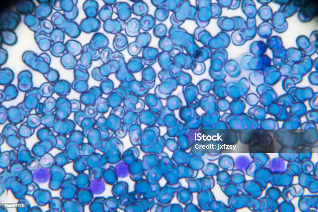 Leucemia linfoblastica acuta ALL-L2 striscio di sangue sotto microscopia leggera - Foto stock royalty-free di Leucemia