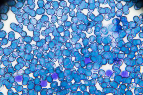 Acute lymphoblastic leukemia ALL-L2 blood smear under light microscopy stock photo