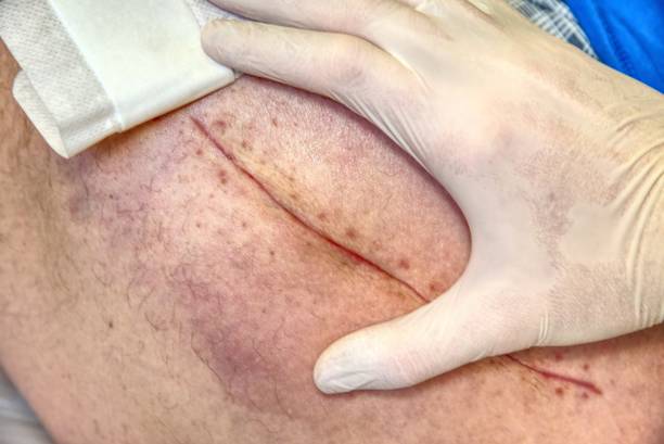 공동 수술의 수술 후 흉터와 인간의 다리  피부의 세부 사항 - pacemaker torso chest male 뉴스 사진 이미지