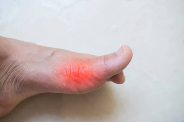 istock Close up Rheumatoid Arthritis.joint injury or arthritis. 966921290