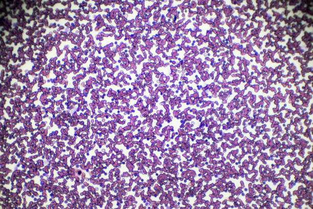 Chronic lymphocytic leukemia (CLL) blood smear under light microscopy stock photo
