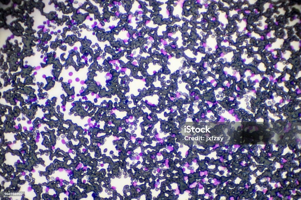 Acute lymphoblastic leukemia ALL-L3 blood smear under light microscopy Analyzing Stock Photo Acute lymphoblastic leukemia ALL-L3 blood smear under light microscopy Analyzing Stock Photo