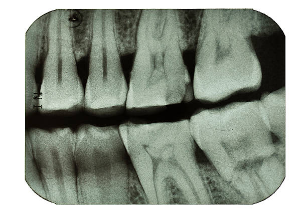 歯科歯 x 線の臼歯 - 歯 写真 ストックフォトと画像