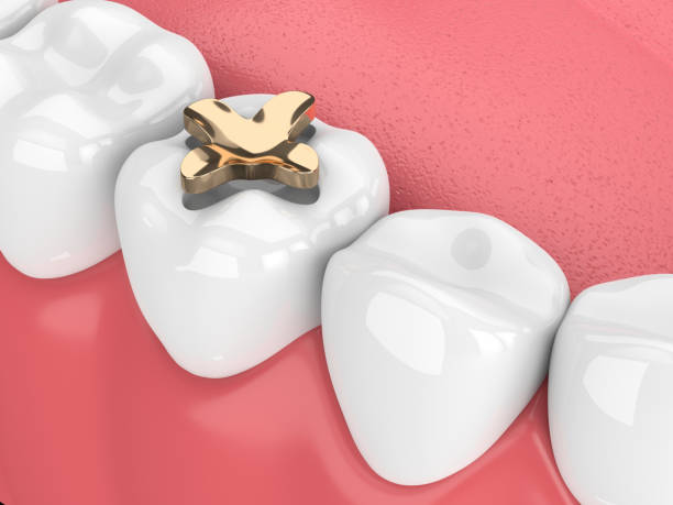 rendu 3d des dents dentaire inlay or fourrée - inlaid photos et images de collection