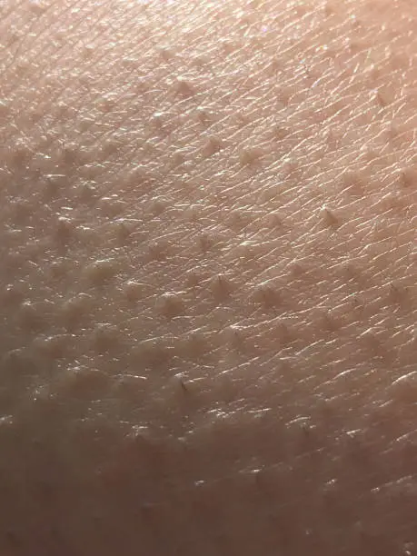 Macro of girl's skin with goose bumps all over and tiny hairs visible just under the skin surface Photo taken in Gainesville, Florida on iPhone 6s