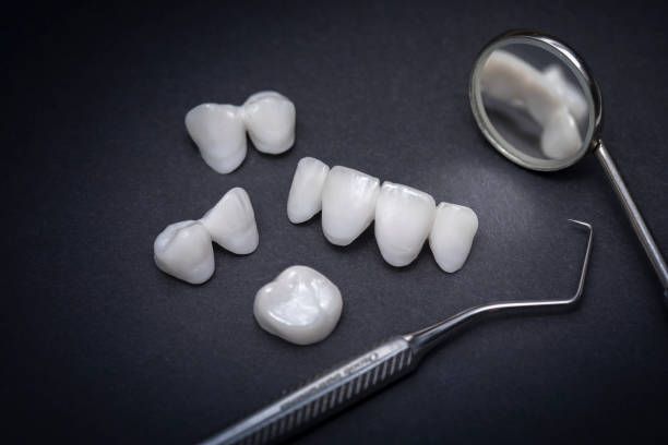 istock Dental tools and zircon dentures on a dark background - Ceramic veneers - lumineers 967792582